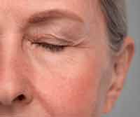 Skin Aging