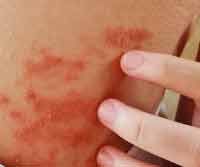 Eczema