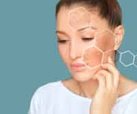 Hyperpigmentation