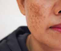 Sun Damage